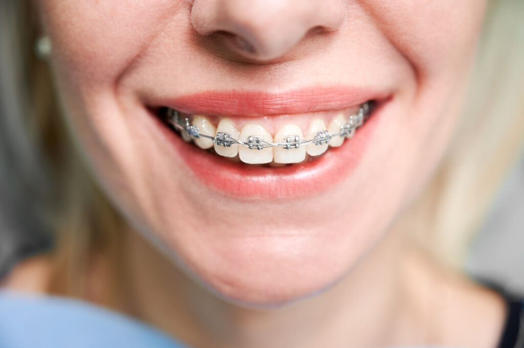 Smiling young woman with braces on teeth.