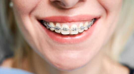 Smiling young woman with braces on teeth.