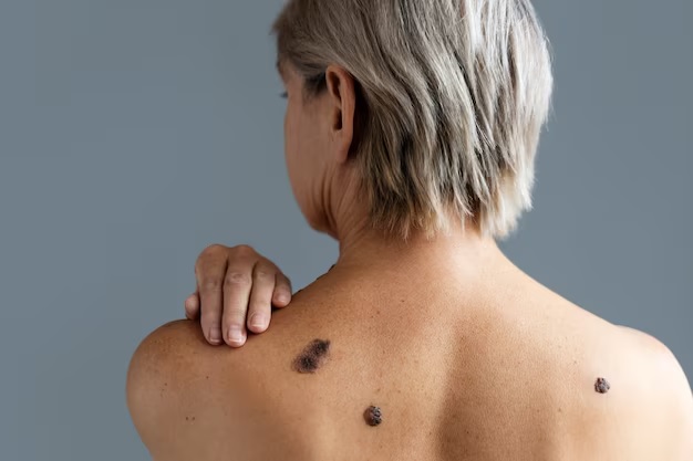 03melanoma