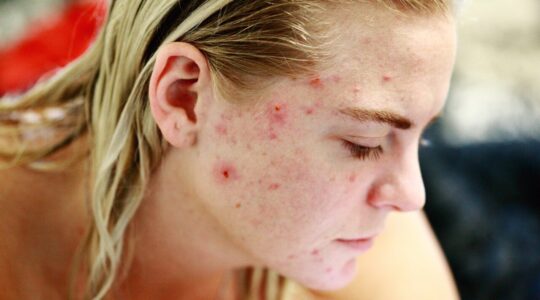 Produtos antiacne estão com descontos de até 46% na Amazon; veja qual escolher