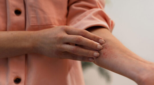 person-dealing-with-rosacea