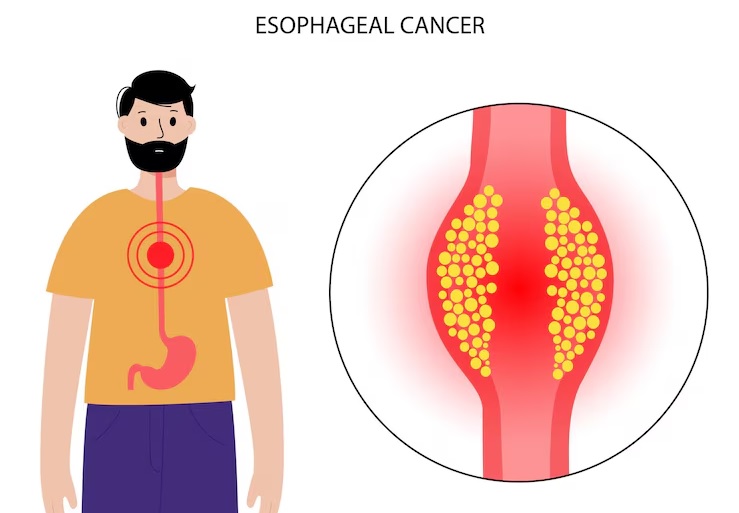 31cancer