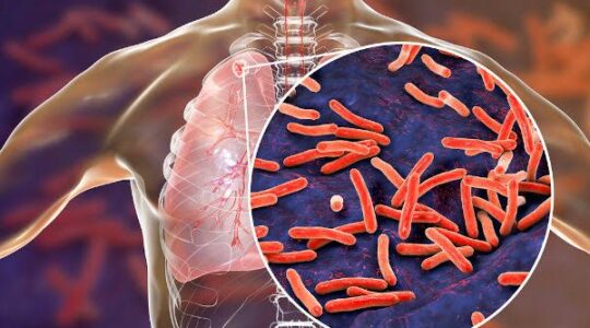 tuberculose