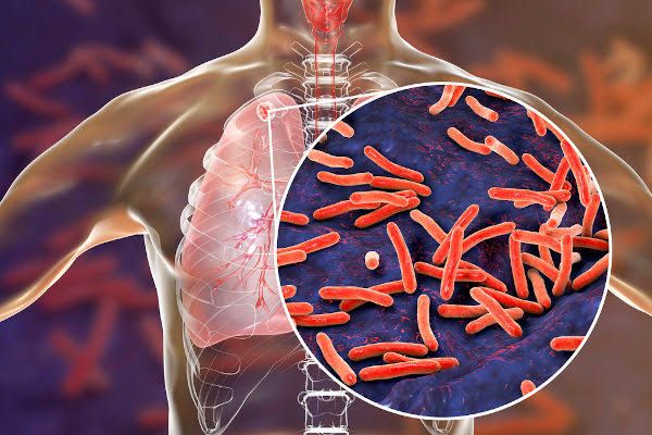 tuberculose