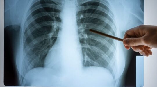 tuberculose
