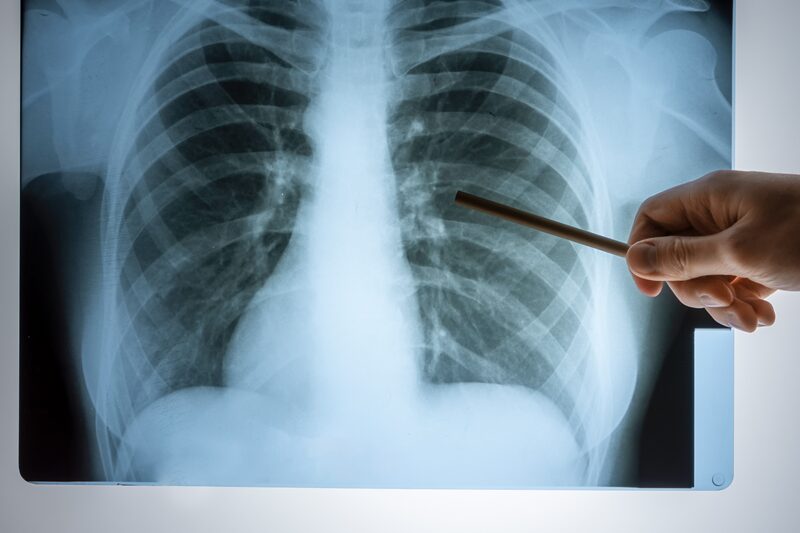 tuberculose
