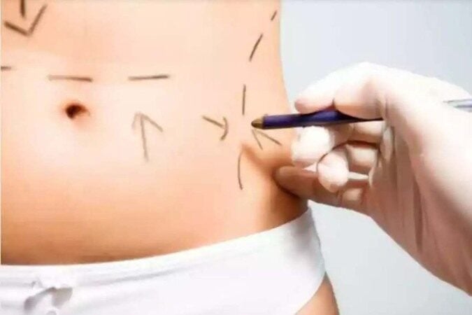 Mitos Cirurgia plástica_Freepik