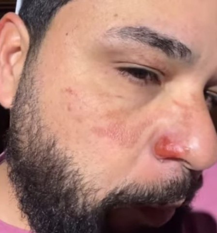 leo queimadura fogo