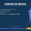 04cancerbexiga