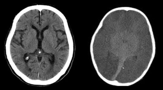 Tomografia de cerebro normal