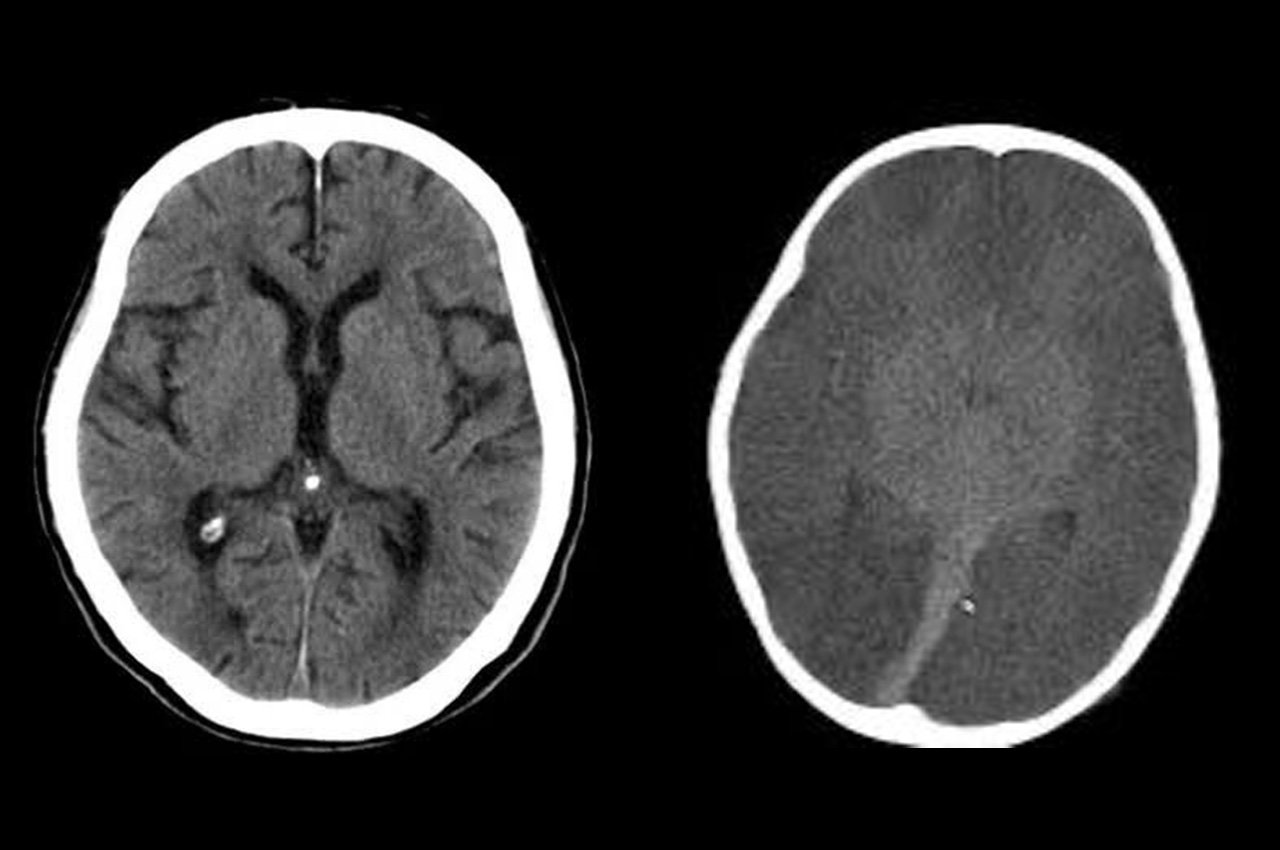 Tomografia de cerebro normal