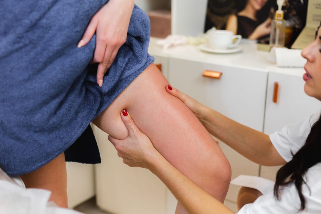 lipedema